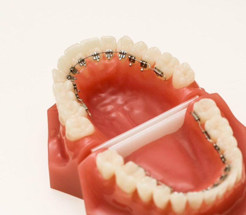 Dentist,Demonstration,Teeth,Model,Of,Orthodontic,Bracket Dentist,Demonstration,Teeth,Model,Of,Orthodontic,Bracket